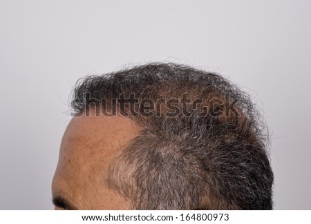 six months after hair transplant surgery
