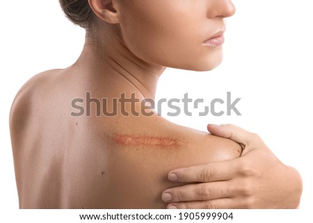 Woman with a scar on her shoulder over white background Imagine de stoc © 