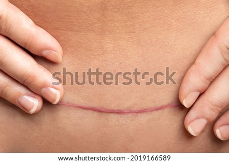 Closeup of scar after C-Section surgery on female belly Imagine de stoc © 
