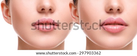 Female lips  before and after augmentation