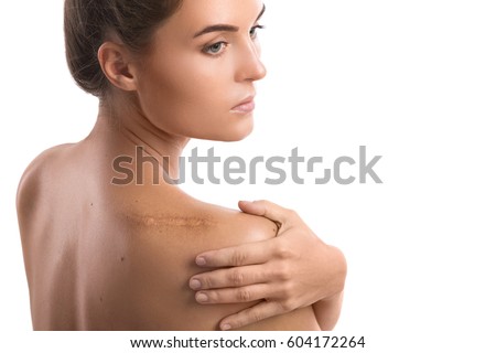 Woman with a scar on her shoulder over white background Imagine de stoc © 