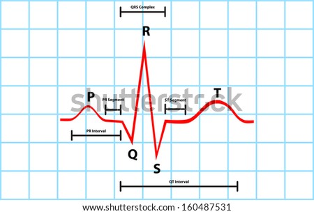 Normal Atrial And Ventricular Depolarization With Electrocardiogram ...