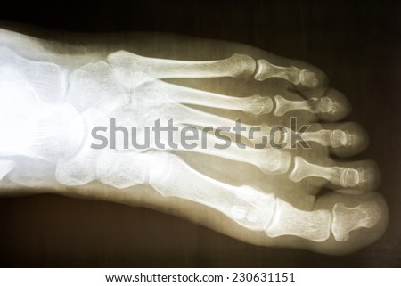 Human Foot X-Ray On Black Background