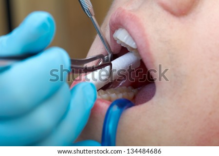 The dentist drill the tooth with a turbine