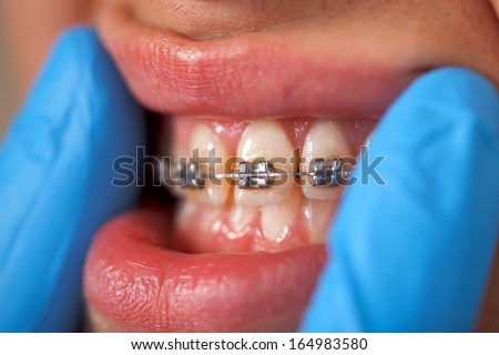 Close up of a dental braces at a dental clinic