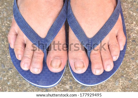 Feet with dirty toe nails