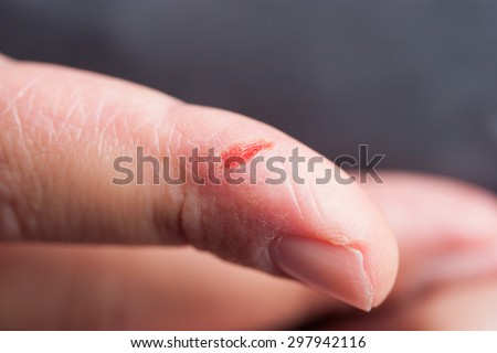 Forefinger hurt with red cutout skin showing