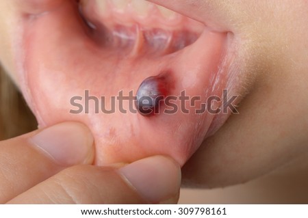 A blood blister on the lower lip open mouth