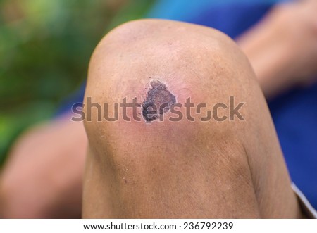 Dried wound on knee.