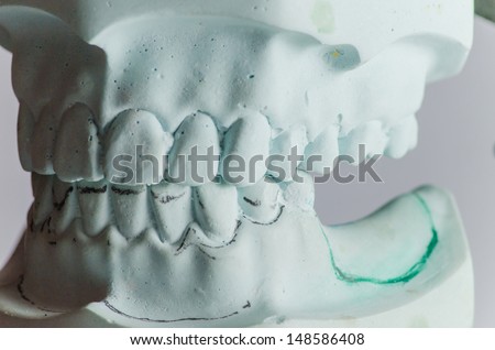 Dental Cast with Edentulous Arch and Survey Line