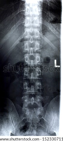 X-ray: lumbar spine front view