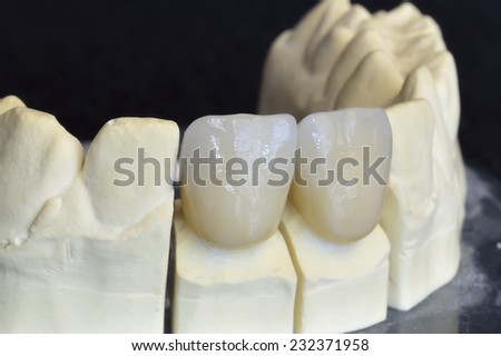 Upper incisors zirconium, particular of the working Multilayer Ceramic.