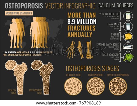 Osteoporosis in the world. Medical infographic poster. Healthcare, medicine and early prevention concept. Landscape format. Vector illustration with useful facts and advices.