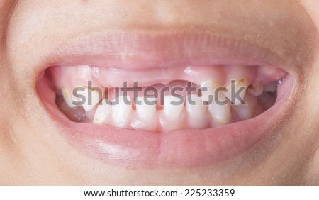 broken tooth,smiling child