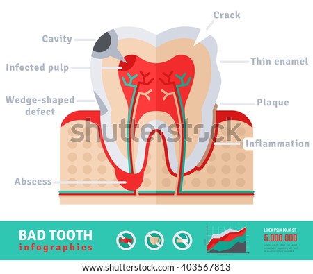 Bad tooth anatomy flat icon concept. Teeth infographics.Vector illustration. Infected pulp and nerves, thin enamel, plaque. Abscess.