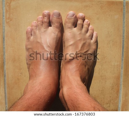 Broken ankle, mens feet