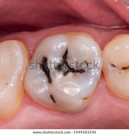 decaed tooth {caries} before treatment Сток-фото © 