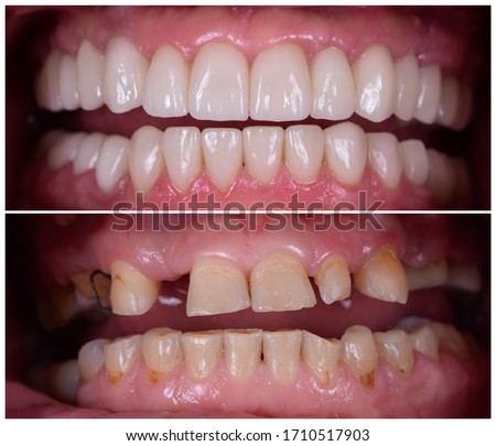 full mout recovery by press ceramic crowns and implants