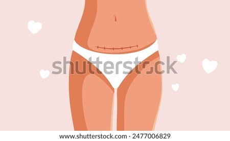 
Woman Proudly Showing Her C Section Vector Cartoon Illustration. Postpartum body of a new mom with love scar 
