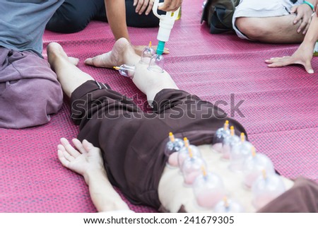 Chiangmai, Thailand - November 8, 2014: leg and back skin cupping vacuum, the chinese alternative medicine for detoxifying
