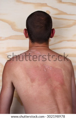 Sunburn back from a man and peeling skin