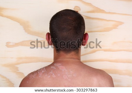 Sunburned peeling on back body a man