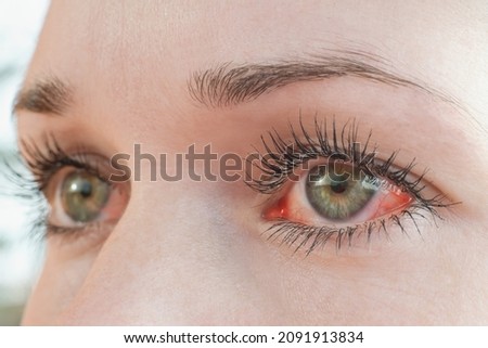 Red irritated human eye close up, allergy symptom Stok fotoğraf © 