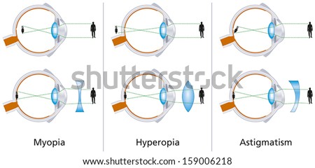 Illustration of the three visual defects Myopia, Hyperopia and Astigmatism and how to correct it with biconcave and biconvex lenses - with glasses or contact lenses.
