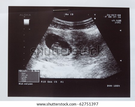 Boy fetus 3 months in the womb. Visible face, arms, legs, stomach