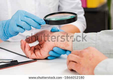 A dermatologist wearing gloves examines the skin of a sick patient. Examination and diagnosis of skin diseases-allergies, psoriasis, eczema, dermatitis. Zdjęcia stock © 