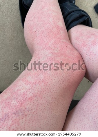 mottled skin heat rash hives allergy reaction on knee close-up reference picture of blotchy mottled red skin erythema ab igne also known as EAI this can also happen at end of life situations  Photo stock © 