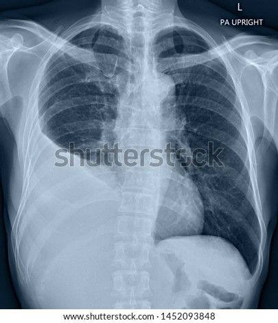 Film x-ray chest. Moderate loculated right pleural effusion. Photo stock © 