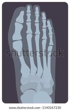 Superior radiograph of human right foot or limb. X-ray picture or radiographic monitor image of metatarsus bones and toes, top view. Medical radiology. Monochrome vector illustration in flat style