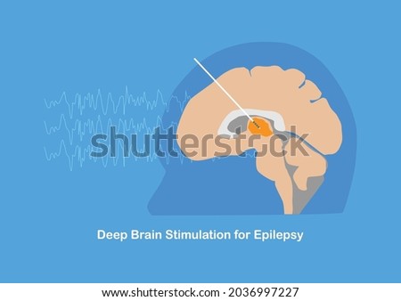 Deep brain stimulation or DBS at anterior thalamic nucleus for treatment of drug resistant epilepsy.