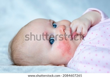Newborn baby with allergic reaction on skin. Skin rush, detoxify. Zdjęcia stock © 