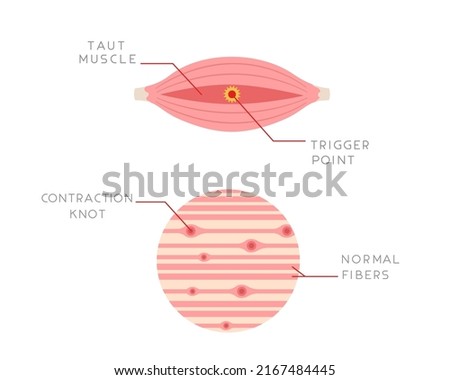 Illustration of a trigger-point complex at a longitudinal section of muscle. Cause of muscle pain. Illustration for anatomy study, medicine or health topics.