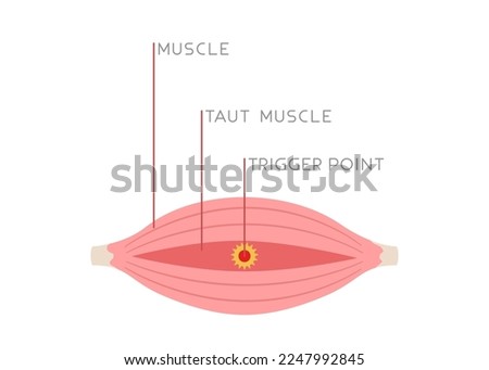 Illustration of tight muscle fibers with trigger point isolated on white background. Concept of injury, muscle pain, Myofascial pain, medical illustration. Flat vector.