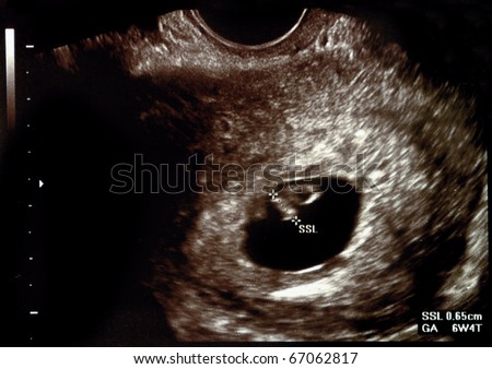Ultrasound scans during pregnancy in the seventh week