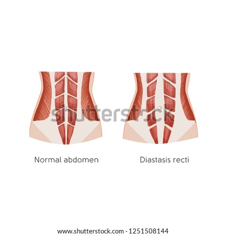 Diastasis recti. Abdominal muscle diastasis after pregnancy. Abdominal problems. Anatomy vector illustration.