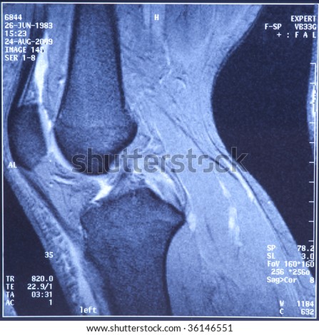My Knee Mri - Sport Trauma, Damage Of Cross-Shaped Ligaments Stock ...