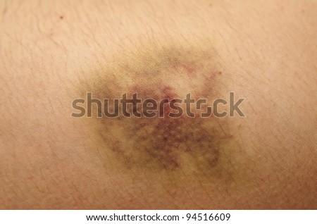 Nasty Looking Bruise On Hip, Macro Shot Stock Photo 94516609 : Shutterstock