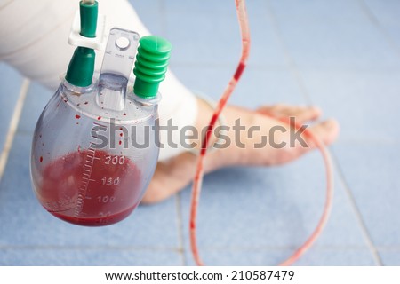 vacuum bottle for draining blood from leg patient