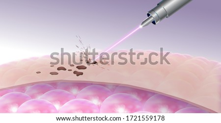 Details for laser freckles and dark spot removal On the upper skin Does not affect the cells under the skin. Realistic file.