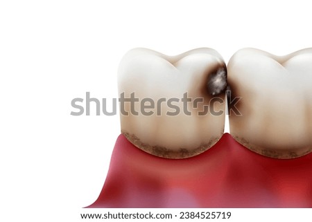 Close-up of tooth decay and plaque. Isolated on white background. Realistic vector illustration file.