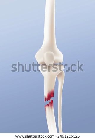 Close-up image of broken leg bone. Realistic vector illustration.