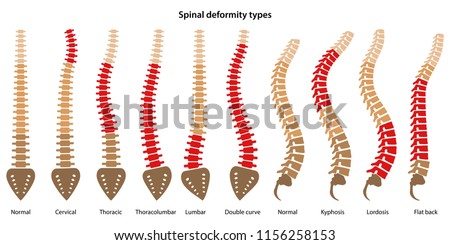 Spinal deformity types. Diagram with marked sections. Vector illustration Foto d'archivio © 