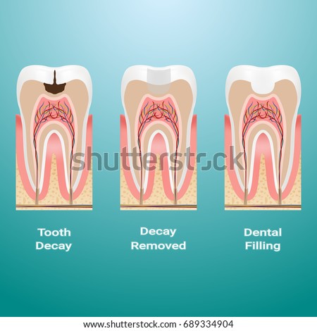 Treatment Of Caries. Dental Filling. Dental Caries Detailed Isolated On A Background. Vector Illustration. Stomatology. Teeth And Tooth Concept Of Dental