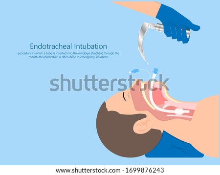 Endotracheal intubation ICU care unit COVID 19 larynx  throat rescue surgery mouth Tube trachea breathe ventilation deliver oxygen lungs insert sedate rest airway foreign body removal block aspiration