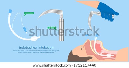 Endotracheal intubation ICU care unit COVID 19 larynx  throat rescue surgery mouth Tube trachea breathe ventilation deliver oxygen lungs insert sedate rest airway foreign body removal block aspiration