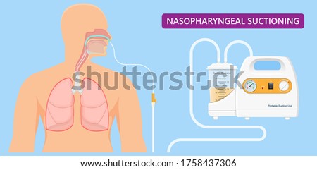 Suction adult nares unit lung clear fluid tube nose nasal pump treat nurse airway clinic device portable mucus oxygen emergency examination therapy sick anaesthetist pharynx pneumonia ventilation Photo stock © 